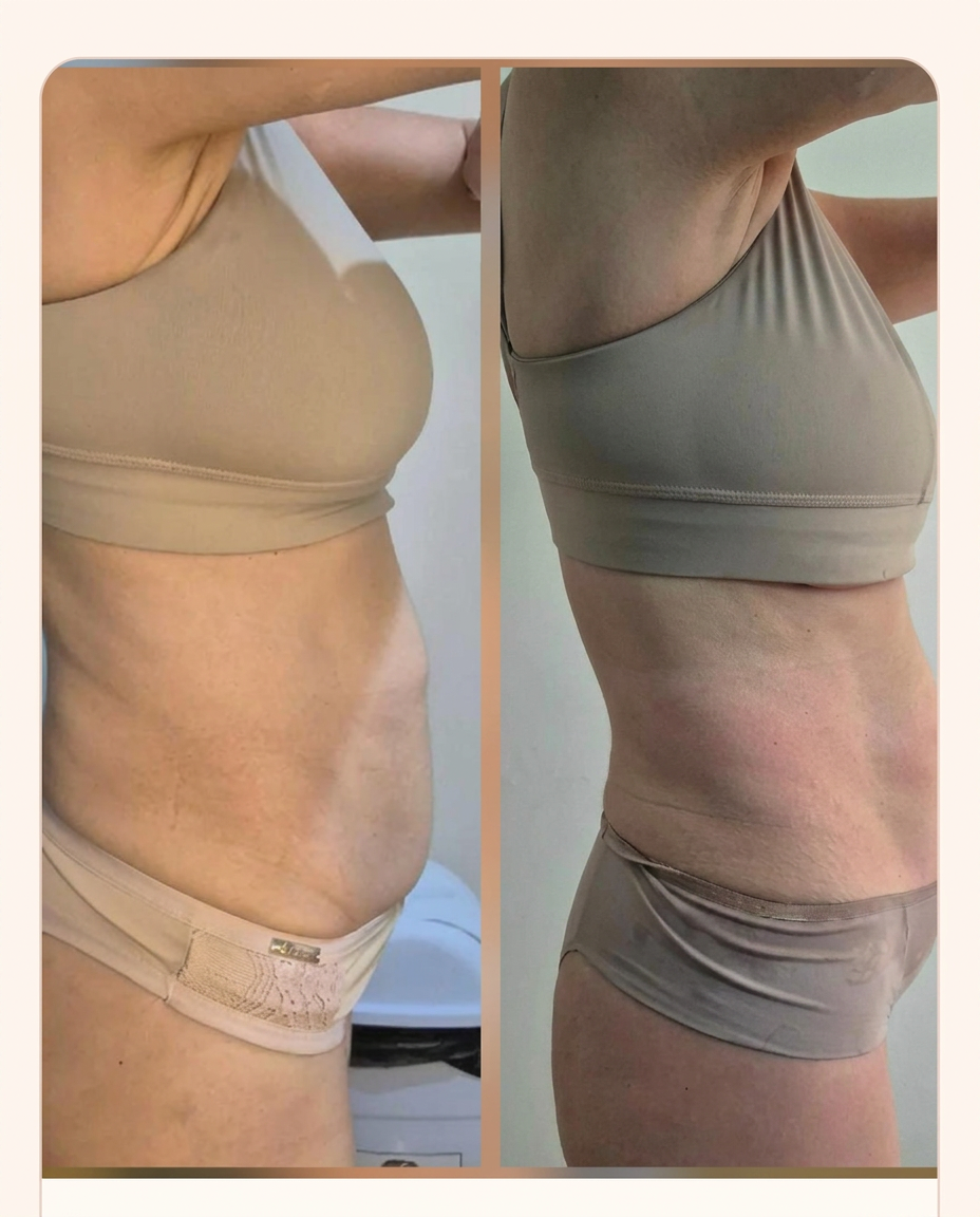 Antes e depois — Combo Emagrecimento