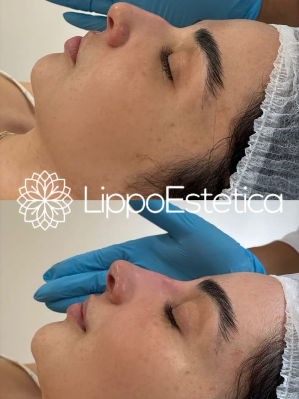 Antes e depois — Harmonização Facial